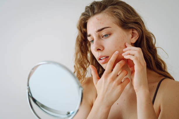 Riyadh’s Top Acne Specialists – Book Now
