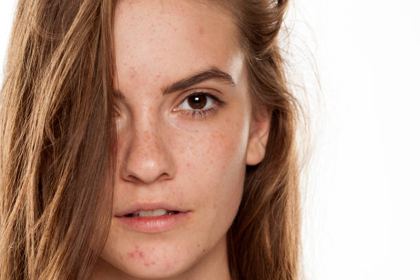 Oily Skin & Pimple Control in Riyadh