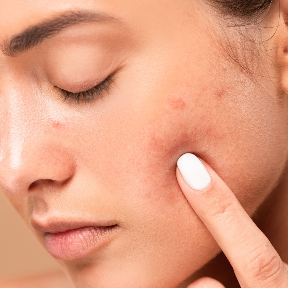 Say Goodbye to Pimples in Riyadh