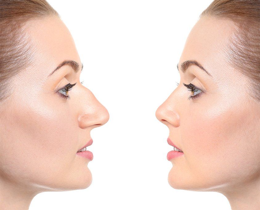 Rhinoplasty Before & After – Riyadh Results