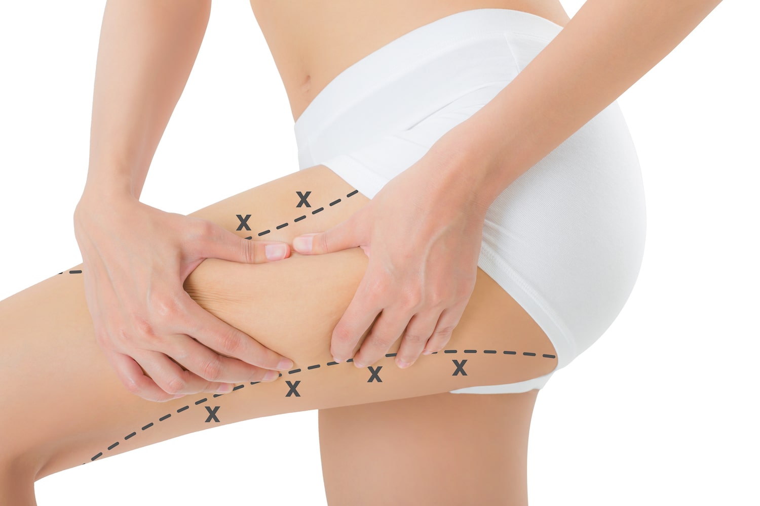 Thigh Lift Recovery Tips for Riyadh Patients