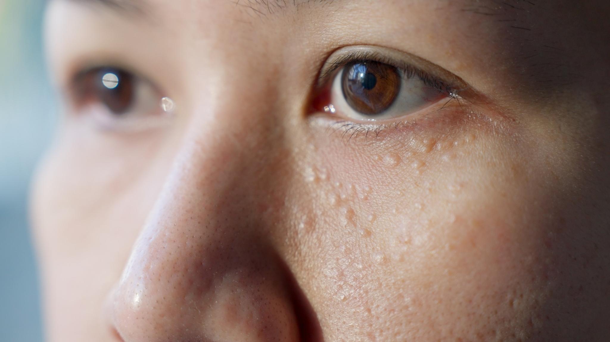 What Are the Most Effective Milia Treatments