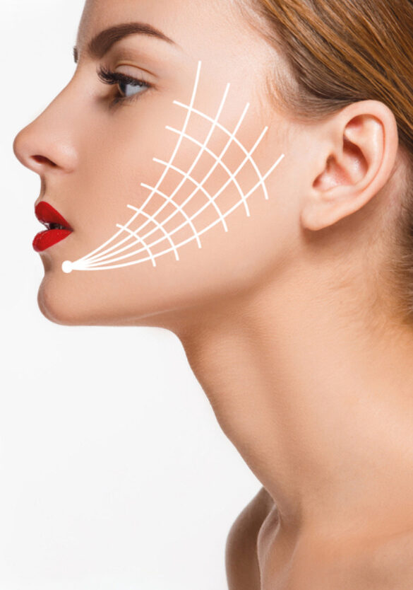 What Areas Can Be Treated With Sugar Thread Lift