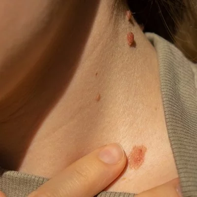 Who Is Eligible for Birthmark Removal Treatment?