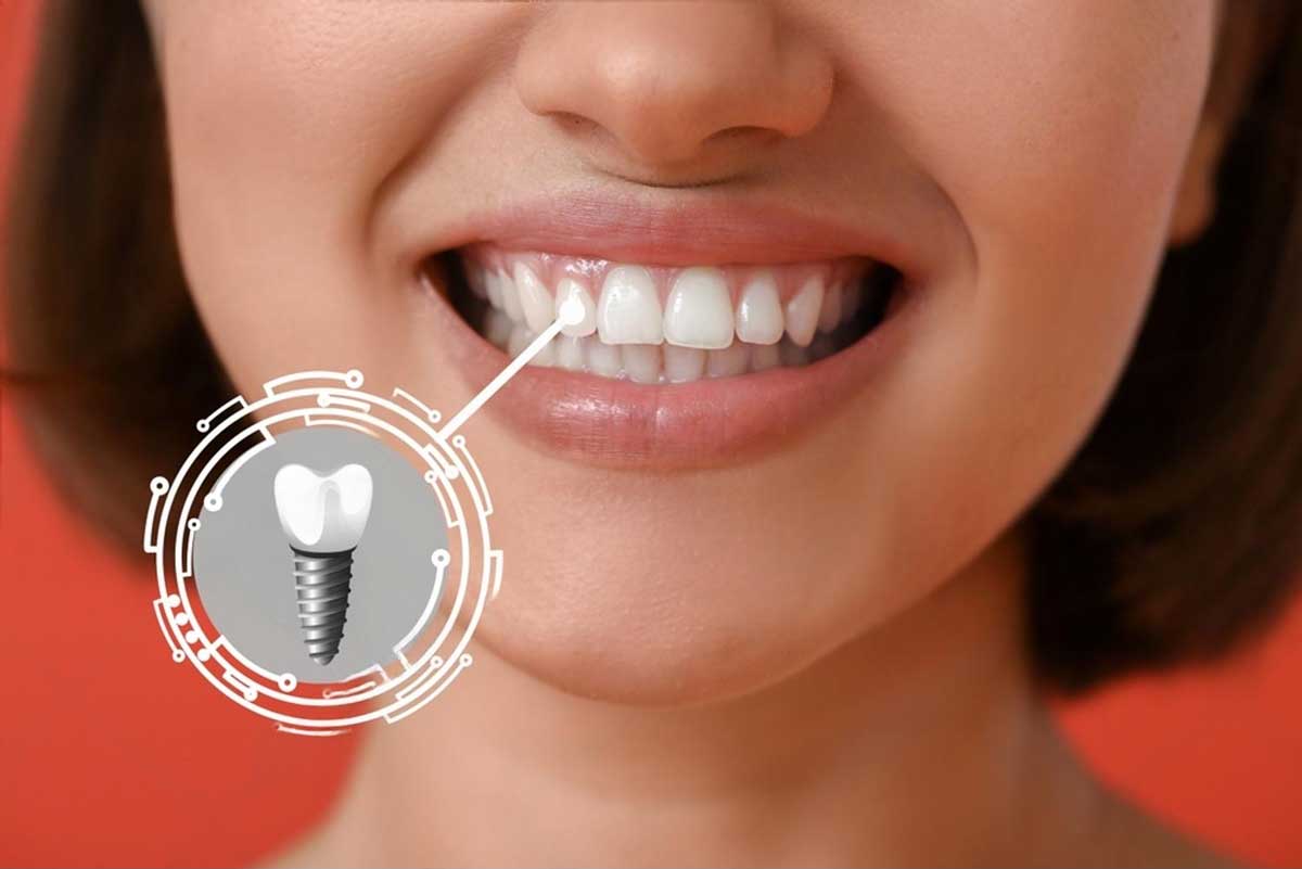 Dental Implants