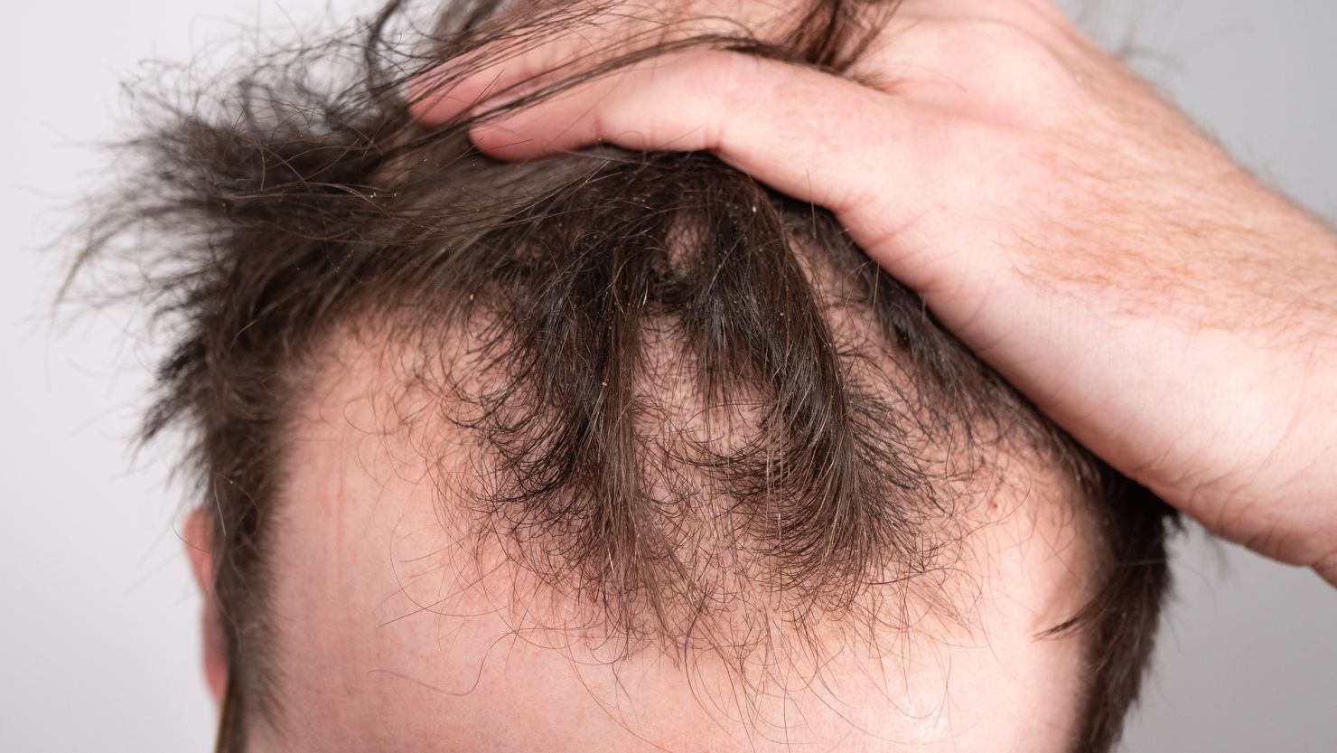 Can Hair Loss Treatments Work for Early Stage Baldness