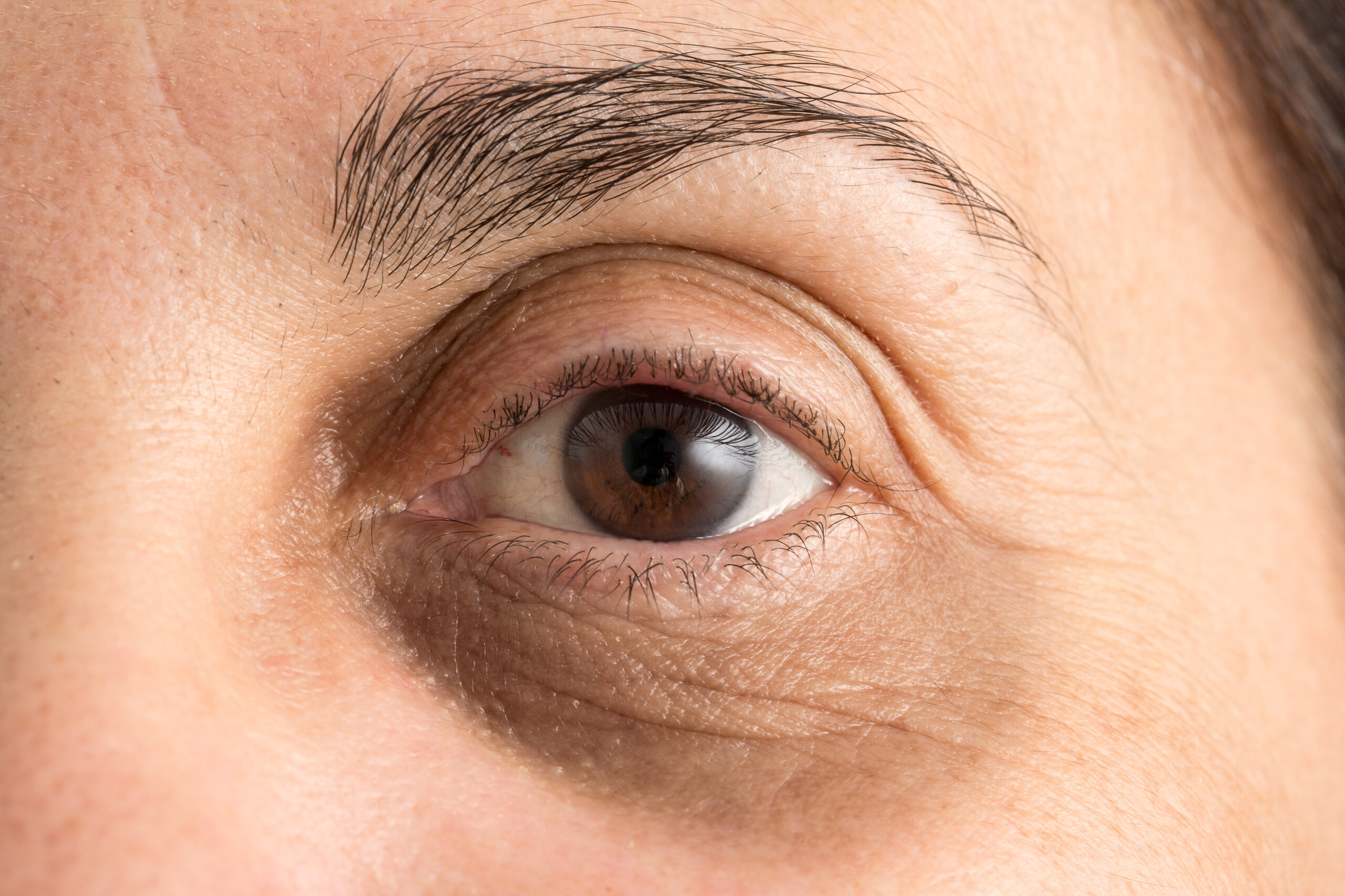Can HydraFacial Help With Dark Circles