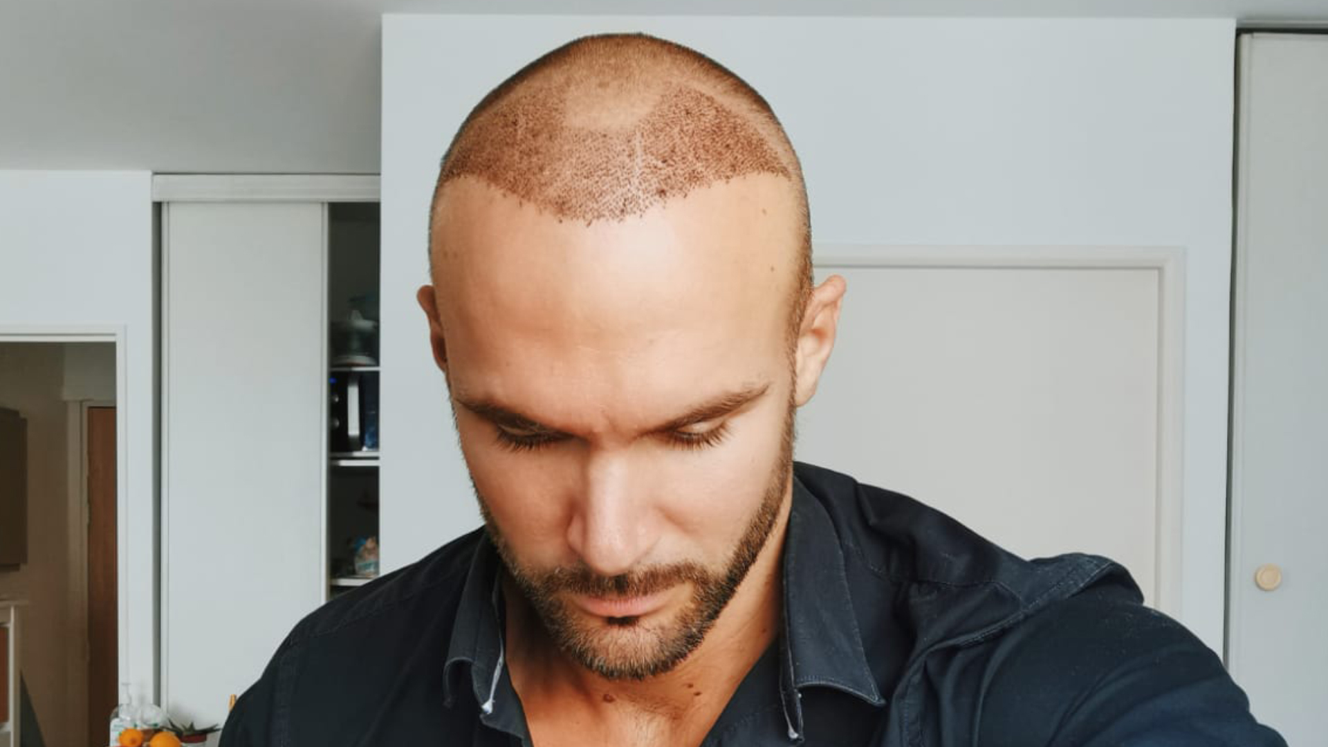 Scalp Micropigmentation in Dubai