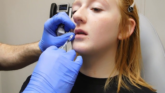 Best Lip Fillers Injections in Dubai