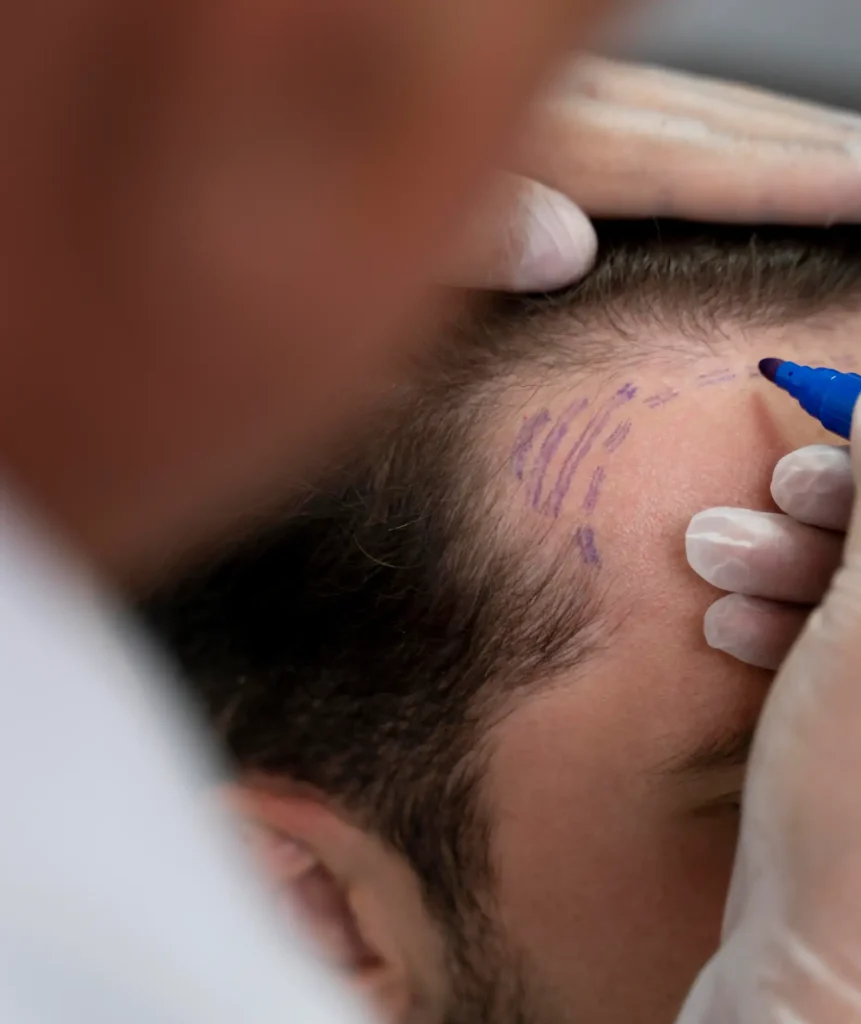 Hair Transplant in Dubai
