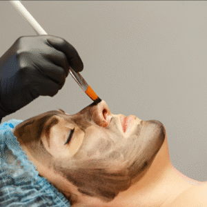 Carbon Peel Treatment