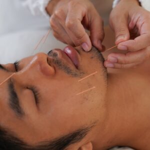 Facial Acupuncture in Philadelphia