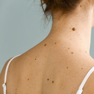 Are Skin Tags Contagious