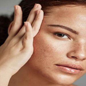 Melasma Treatment in Islamabad