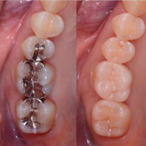 SMART – Dental Amalgam Removal