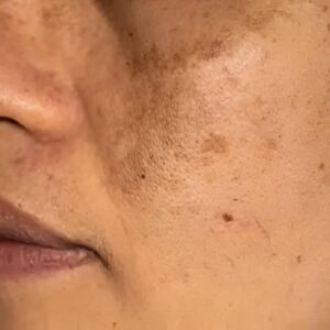 hyperpigmentation treatment in islamabad