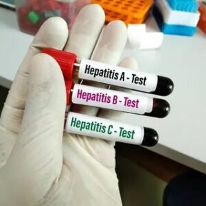 Hepatitis B Test Everything You Need to Know Before Getting Tested